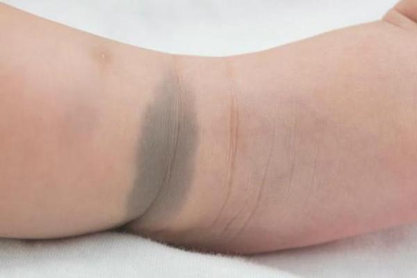 胎记与命理的关系：错认玄机，反而影响命运走向