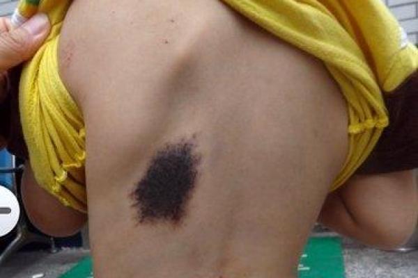 胎记与命理的关系：错认玄机，反而影响命运走向