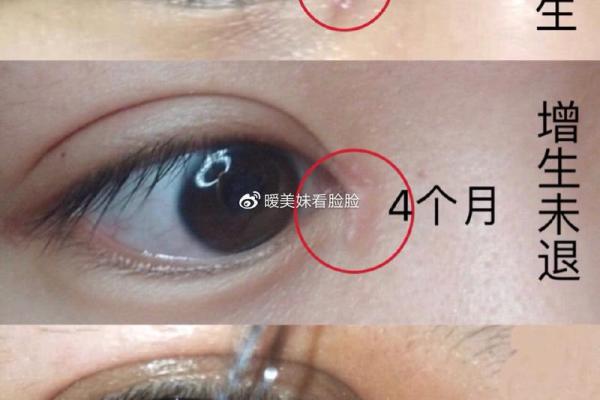 割双眼皮能改变命运密码吗?解密命理中的暗藏玄机 割双眼皮能改变命运密码吗?解密命理中的暗藏玄机